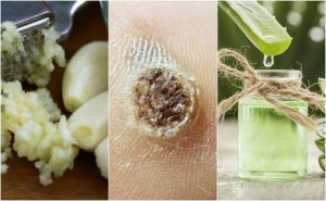 У вас бородавки? 5 засобів для лікування бородавок