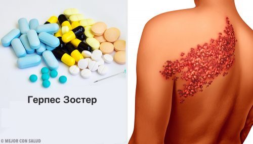 Оперізуючий герпес: що необхідно знати про симптоми та діагностику Оперізуючий герпес: що необхідно знати про симптоми та діагностику
