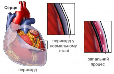 перикардит - одна з причин виникнення болю у грудях