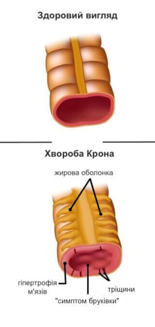 хвороба крона