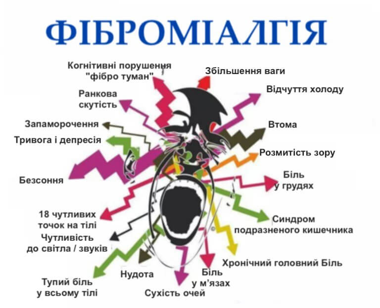 ознаки фіброміалгії