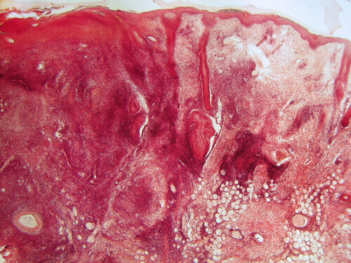 тканини хворого на вовчак