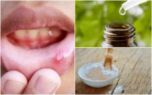 6 натуральних засобів від виразок у роті