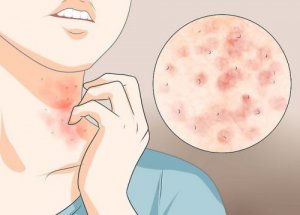 3 прості домашні засоби від корости