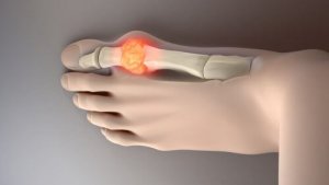 Спробуйте ці 8 продуктів, які ідеально підійдуть, щоб знизити рівень сечової кислоти