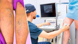 Натуральні місцеві та пероральні способи лікування варикозу