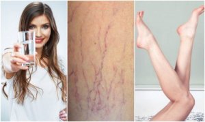 Профілактика варикозу: 6 простих порад