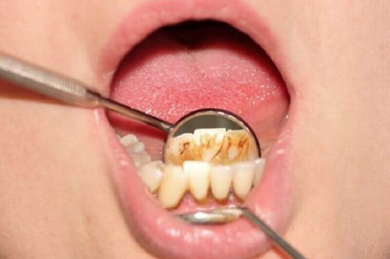 методи видалення зубного каменю