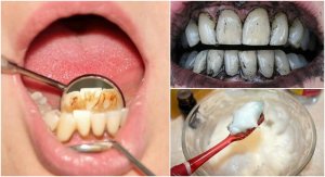 3 ефективні процедури для видалення зубного каменю