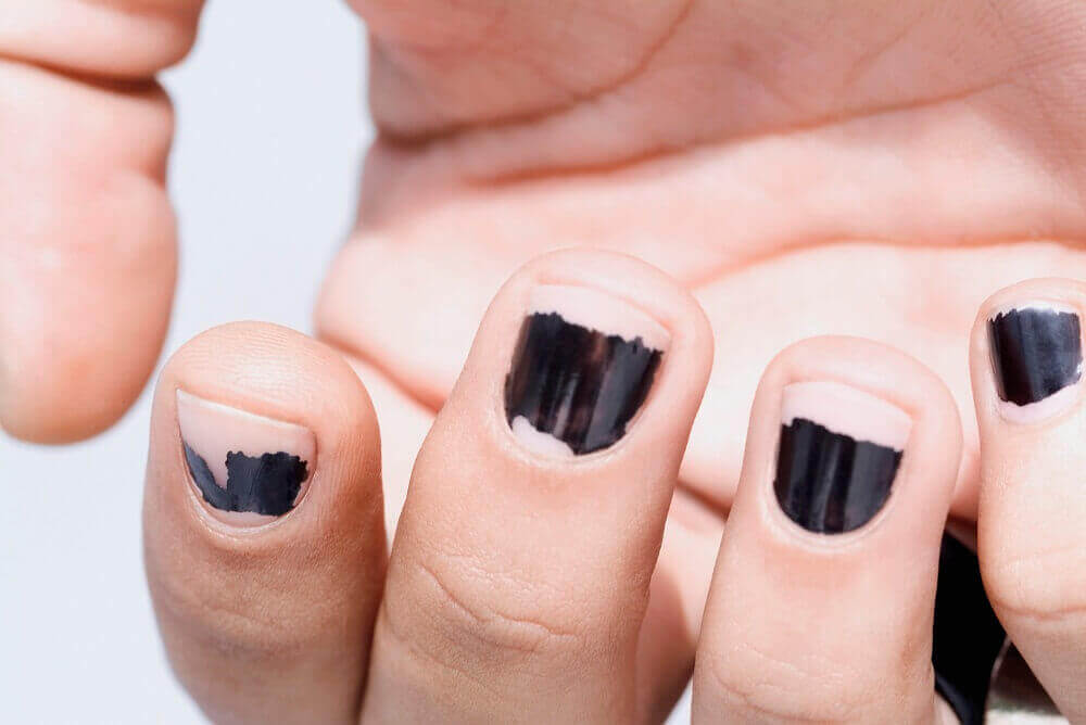 поширені причини ламкості нігтів