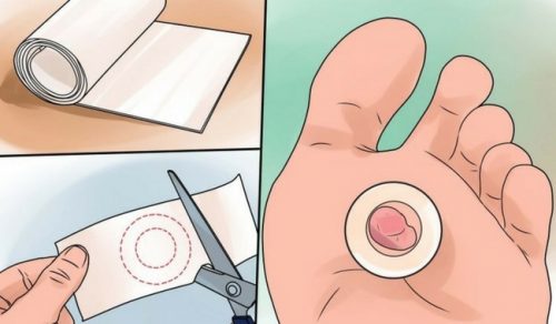 методи усунення пухирів