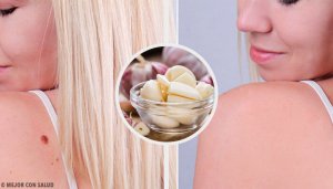 9 способів, як швидко позбутися бородавок