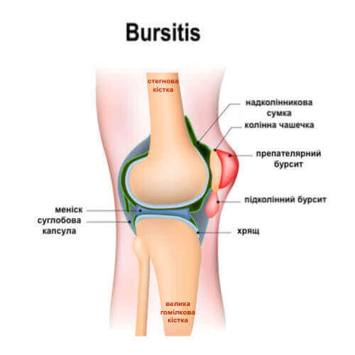 бурсит та особливості захворювання