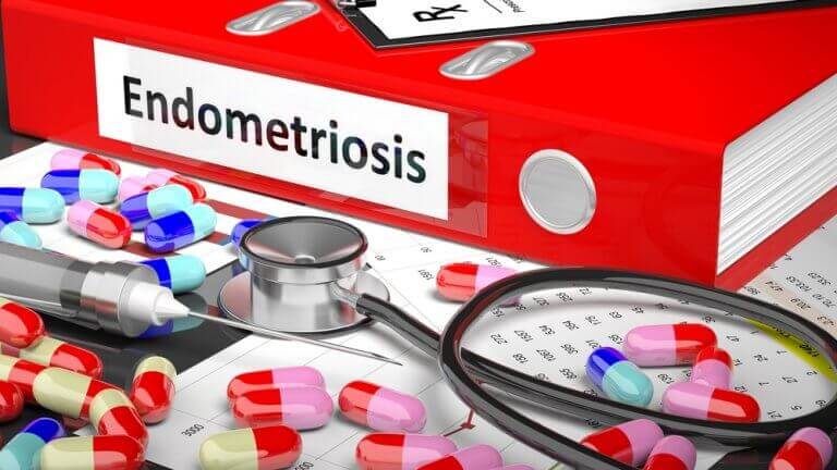ендометріоз та його лікування