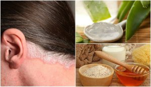 5 домашніх засобів для лікування псоріазу шкіри голови