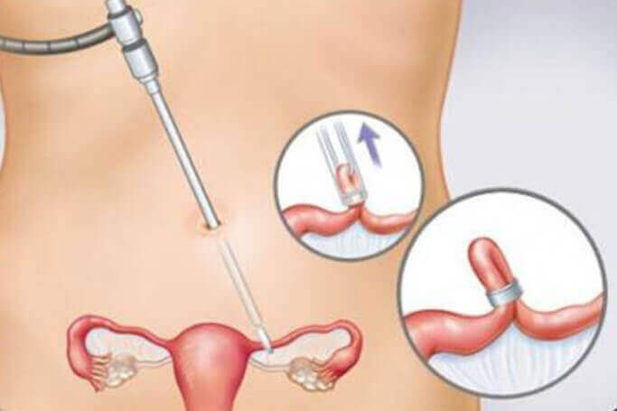 постійні контрацептиви - перев'язка труб