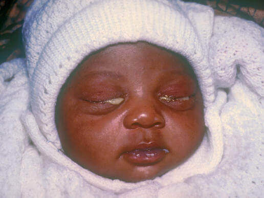 гонорея у дітей