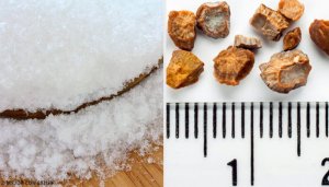 7 домашніх засобів, щоб позбутися каменів у нирках