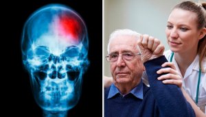 Що таке мікроінсульт та як його вчасно виявити?