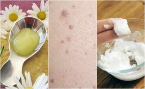 5 натуральних засобів від плоских бородавок