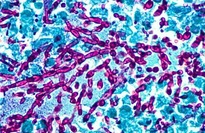 поширені причини вагінальних інфекцій