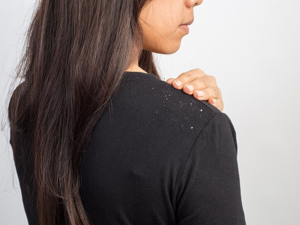 домашні шампуні проти лупи