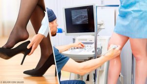 3 способи допоможуть позбутися варикозного розширення вен