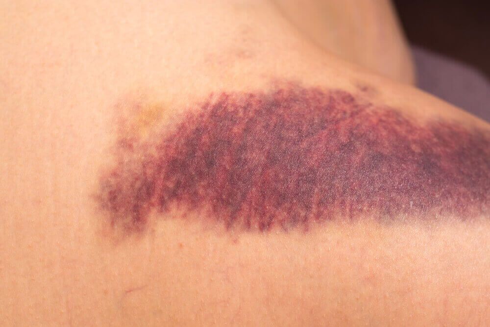 геморагічна висипка пов'язана з нестачею вітаміну К