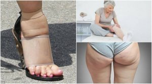 Затримка рідини: 5 найчастіших симптомів