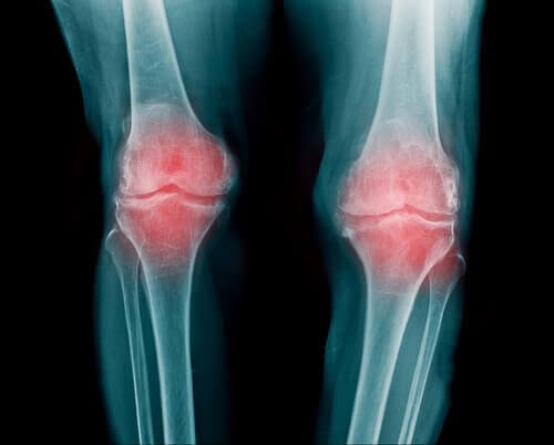 ревматоїдний артрит призводить до поколювання у кінцівках