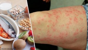 Дізнайтеся про найпоширеніші алергії на харчові продукти та як з цим боротися