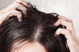 6 найкращих засобів для лікування грибка шкіри голови