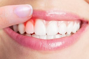 5 найкращих засобів для лікування інфекції ясен