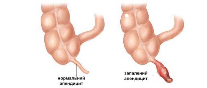 чому виникає апендицит у дітей