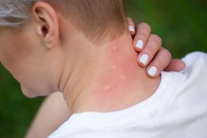 Натуральні засоби для лікування алергій після укусів комах