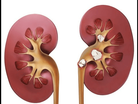 камені у нирках