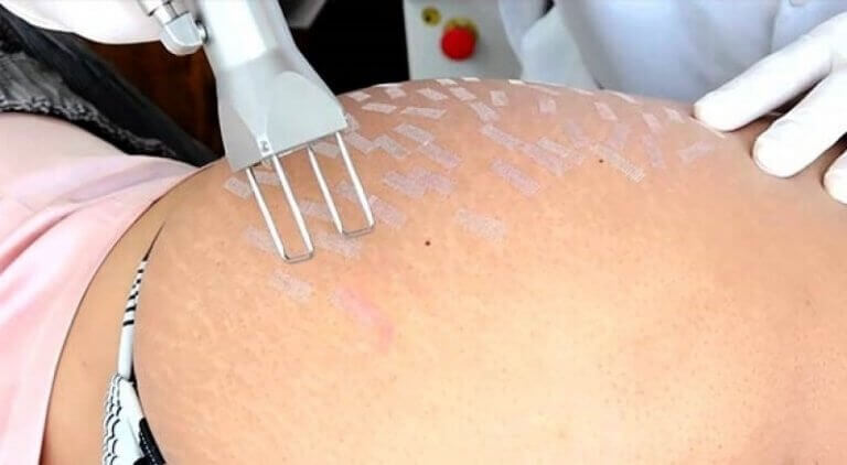 природні засоби проти розтяжок