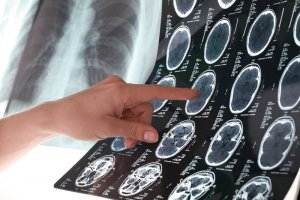 6 порад для запобігання інсульту