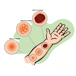 Харчова сода для лікування опіків