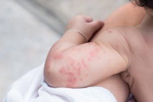 Пітниця у немовлят: чи варто турбуватися?