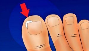 Ефективні методи профілактики вростання нігтів
