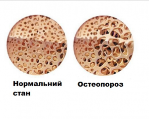 Як контролювати остеопороз в період менопаузи