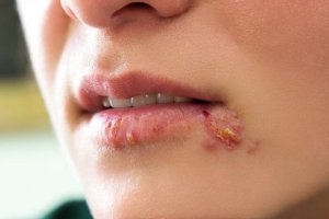Як лікувати герпес у дітей?