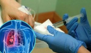 Знайдені ліки, які зменшують побічні ефекти хіміотерапії