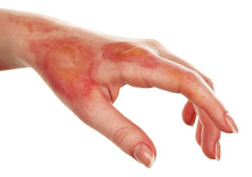 Лікування опіків удома: як виправно лікувати шкоду на шкірі?