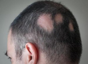 Природні засоби для боротьби з алопецією