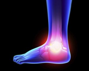 Як правильно лікувати симптоми розтягнення зв’язок