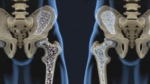Як змінити харчування для профілактики остеопорозу