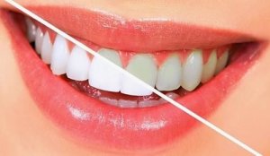 10 продуктів, які відбілюють зуби