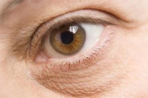 опухлі очі - ознаки дефіциту поживних речовин